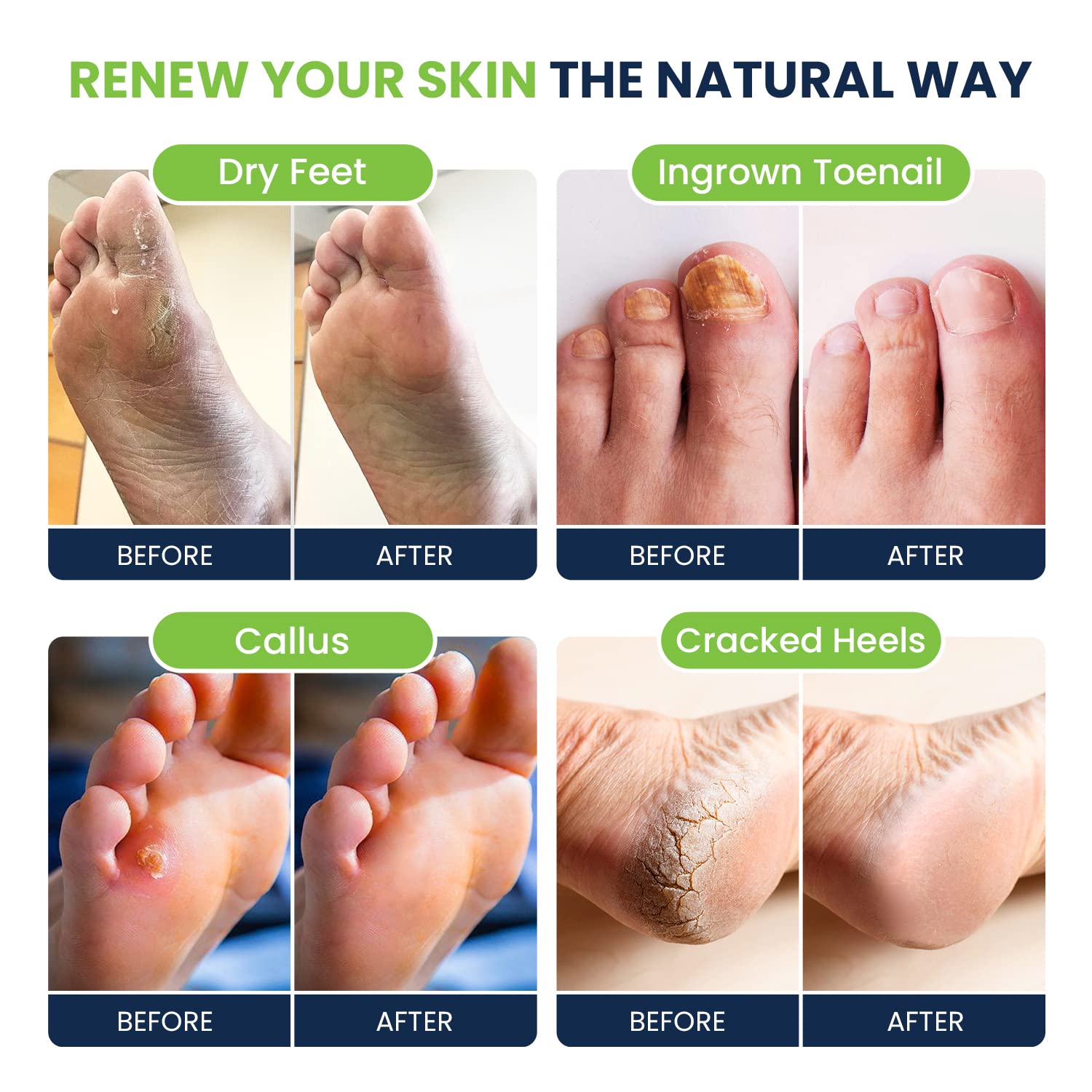 Foot Soak with Epsom Salts- Variety Pack of 4- Tea Tree Oil, Muscle Relief, Calming FOOT CURE Au supplements